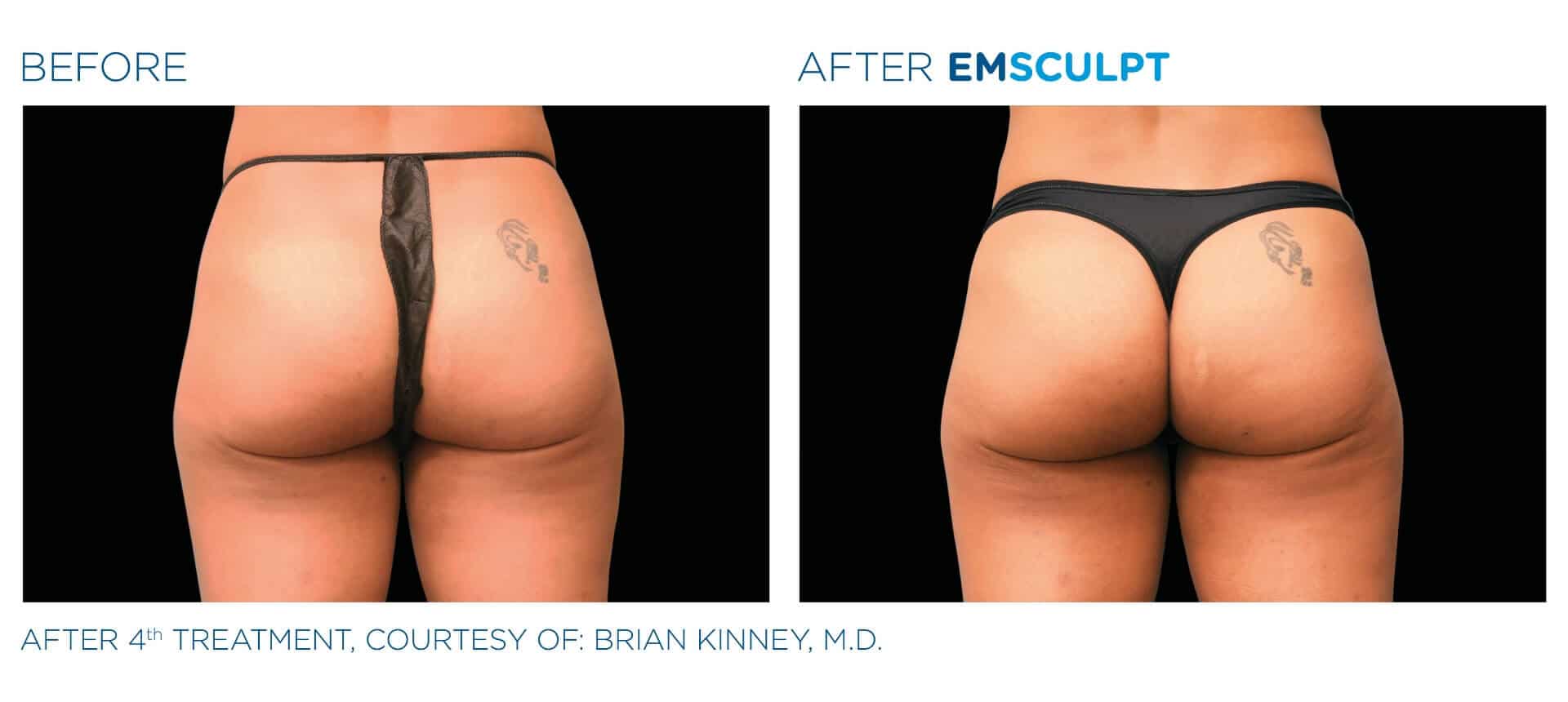 emsculpt before and after 2