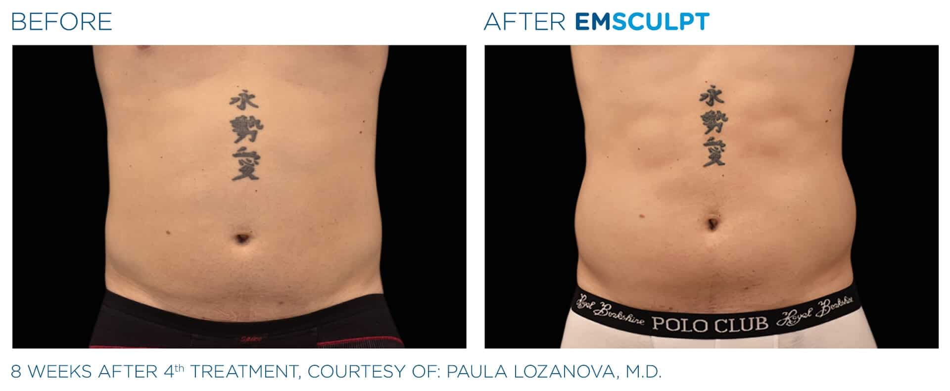 emsculpt before and after 3