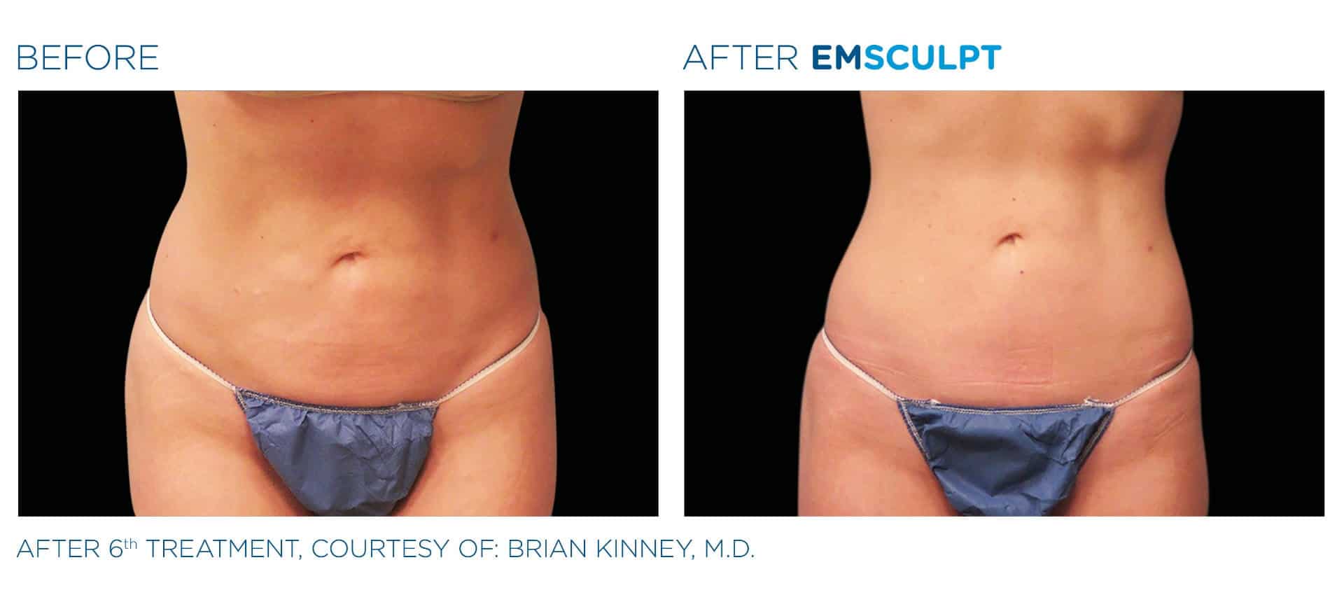 emsculpt before and after 8