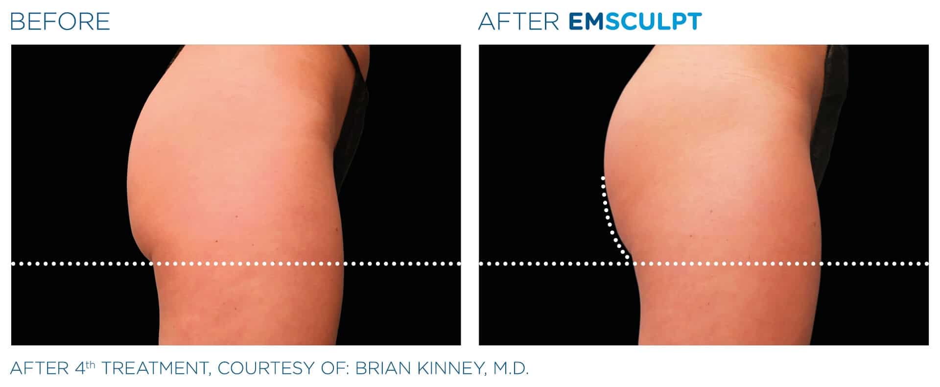 emsculpt before and after 9