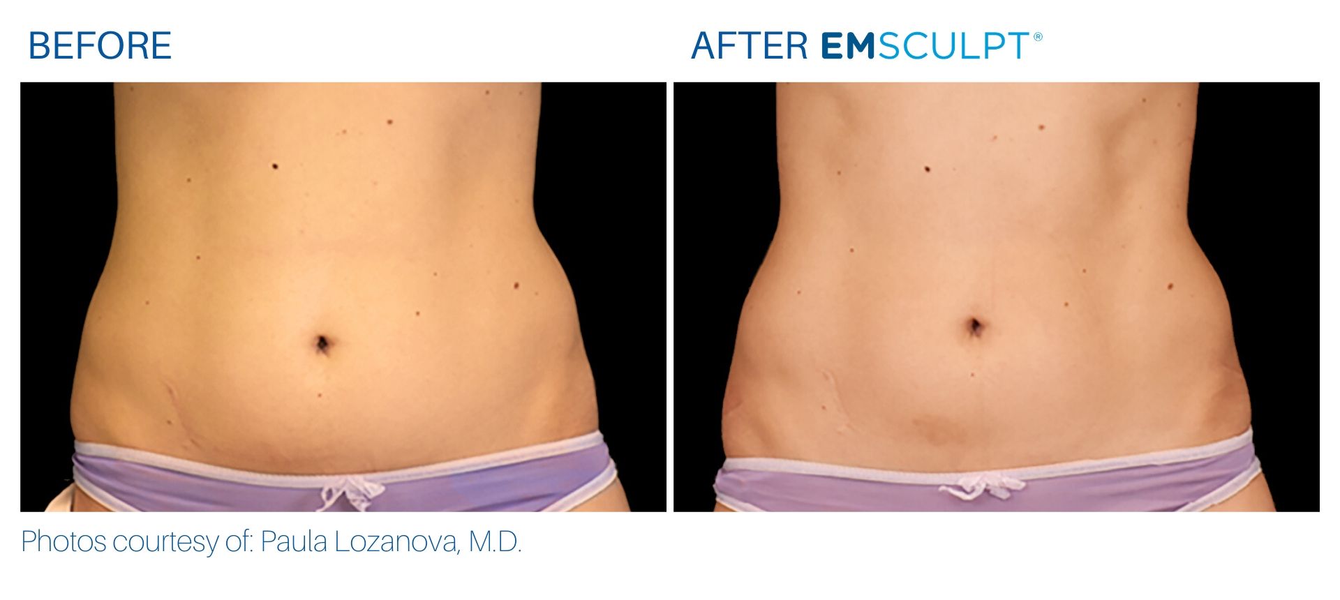 Emsculpt before and after Female Stomach at Body Reflections in Somers, CT
