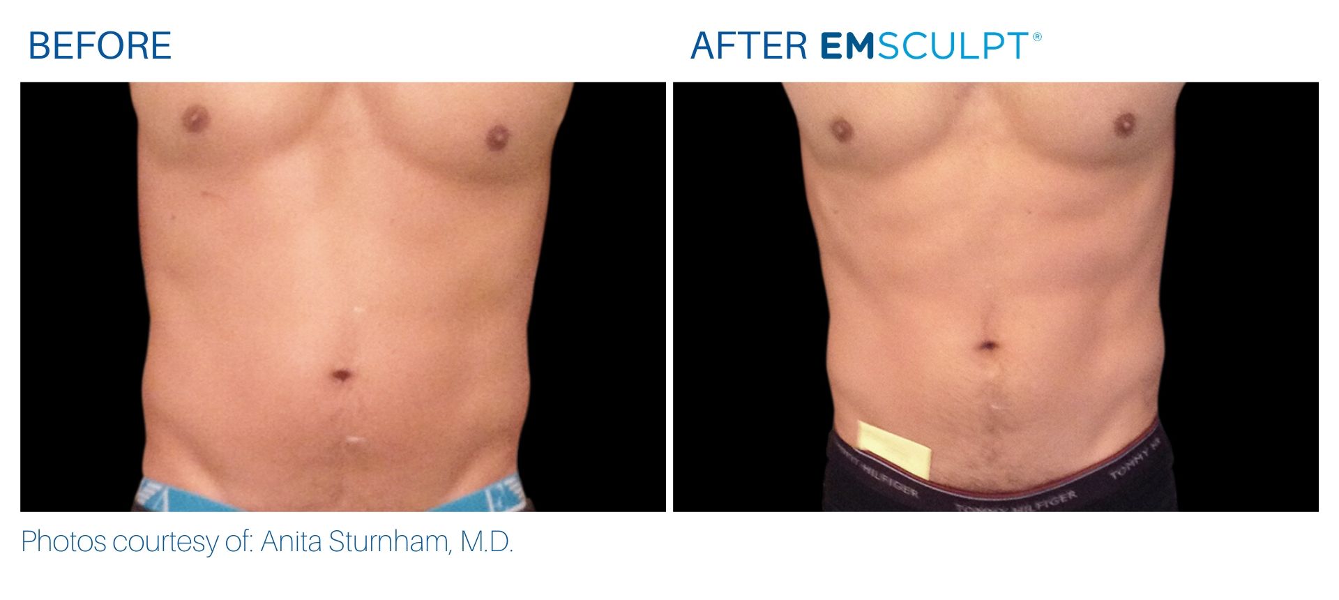 Emsculpt before and after Male Stomach at Body Reflections in Somers, CT