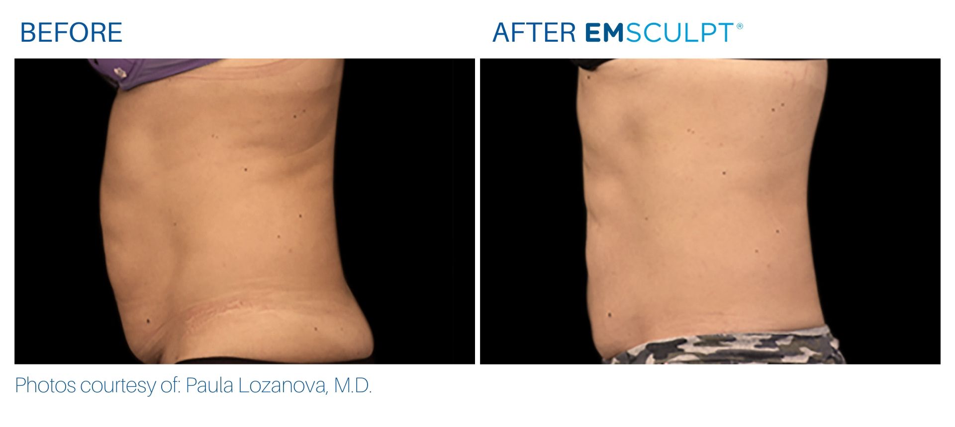 Emsculpt before and after Abdomen at Body Reflections in Somers, CT