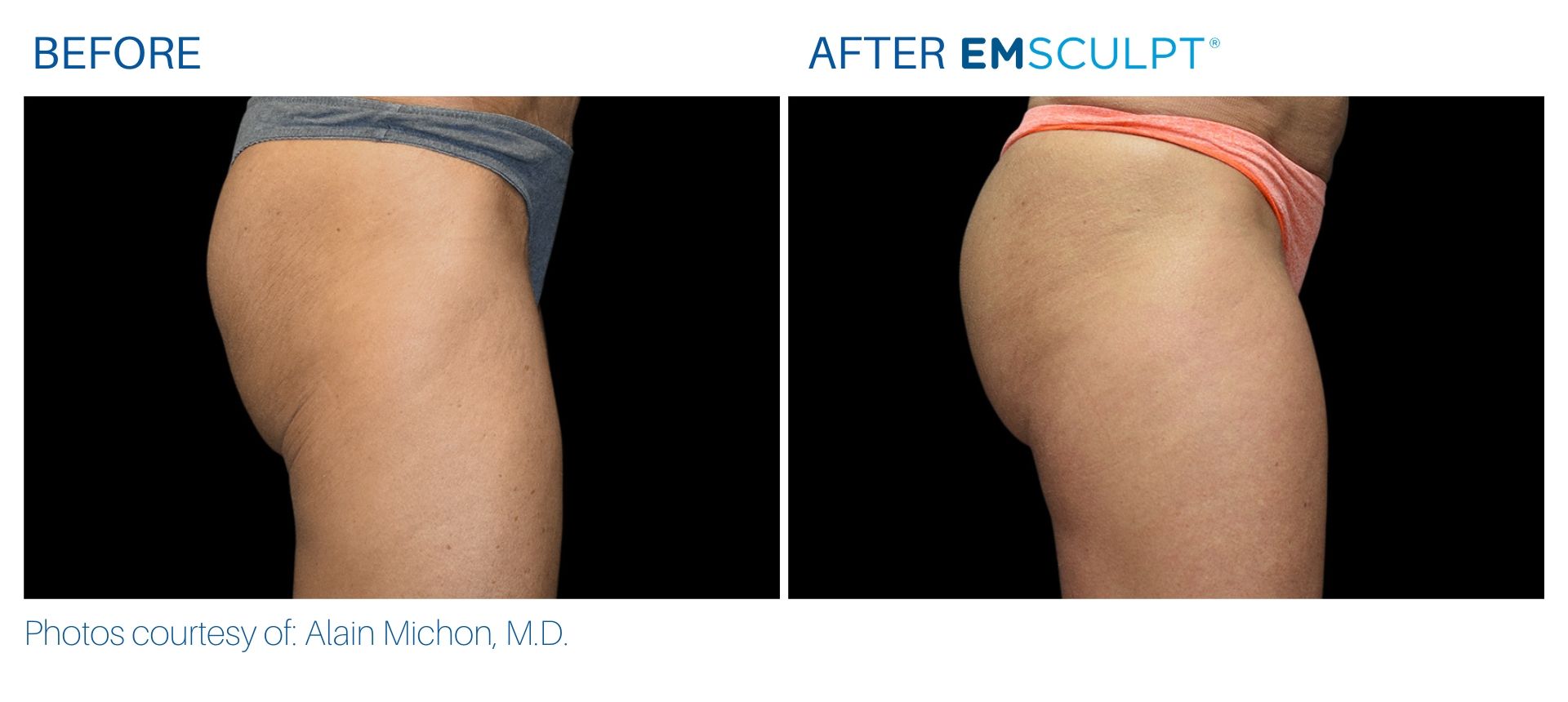 Emsculpt before and after Butt at Body Reflections in Somers, CT
