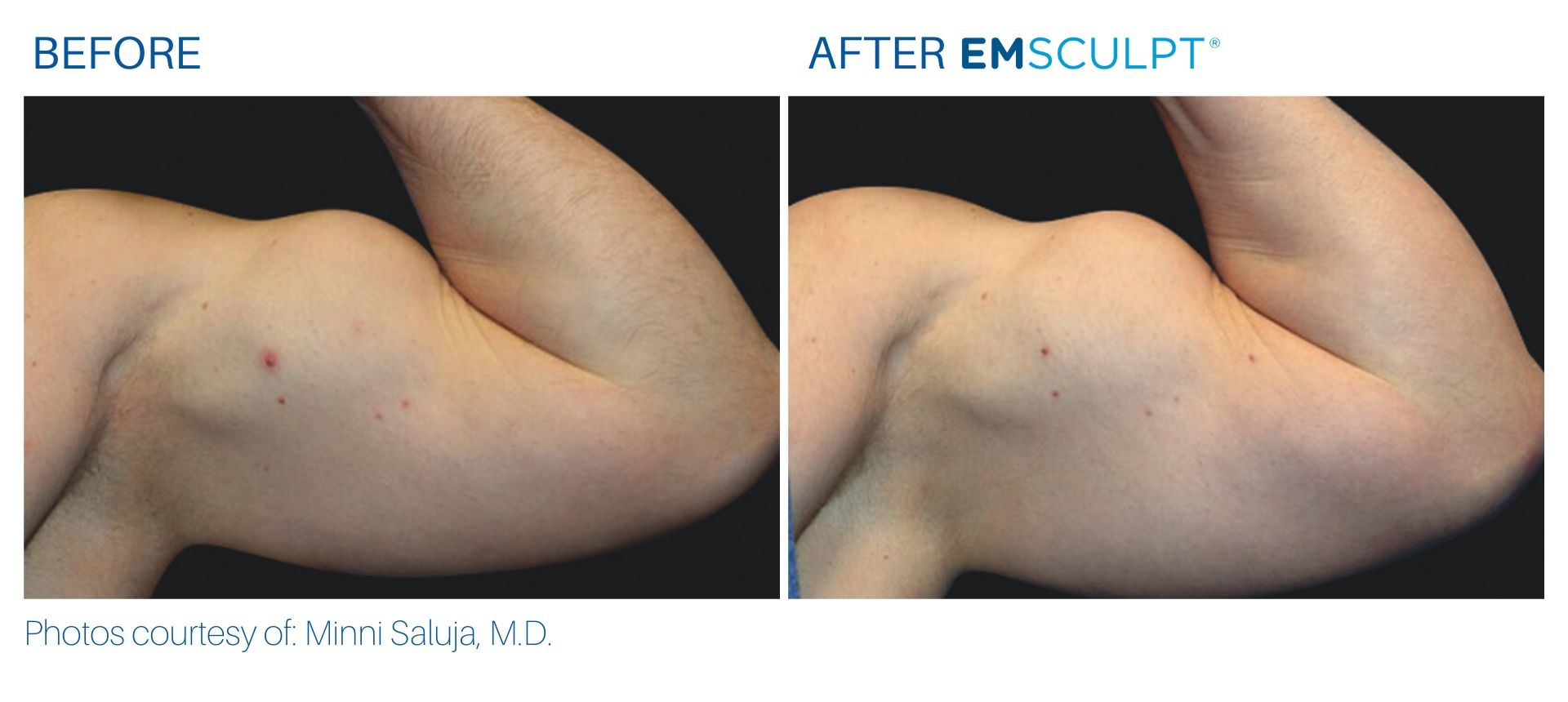 Emsculpt before and after Arms at Body Reflections in Somers, CT