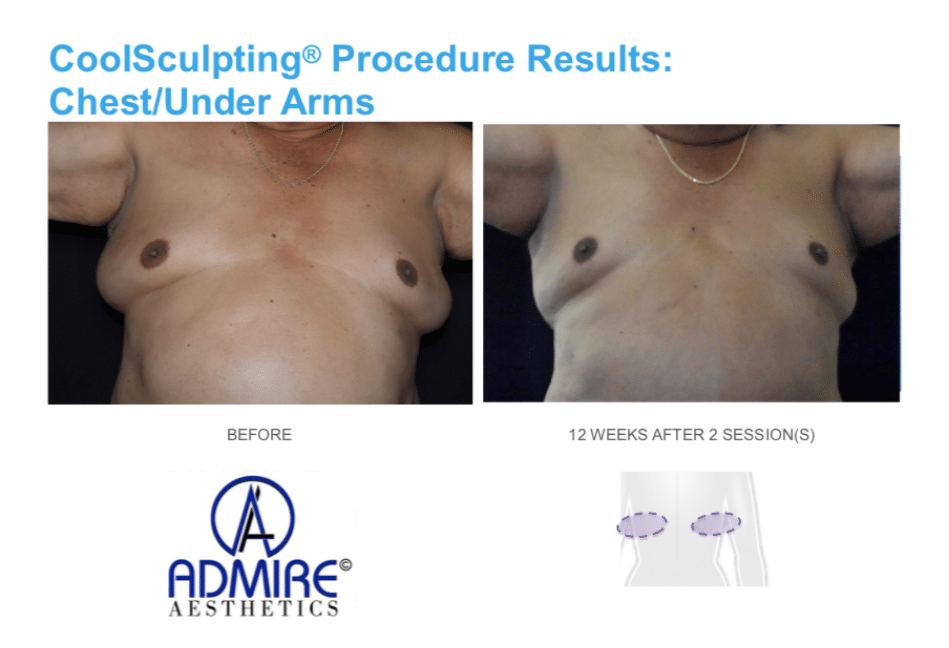 coolsculpting procedure Chest fat on men or moobs area at Admire Aesthetics body contouring treatment for men.