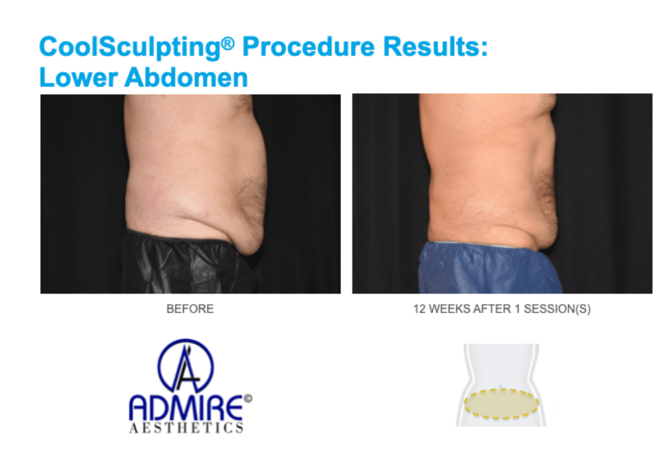 coolsculpting for men abdomen area at Admire Aesthetics body contouring treatment for men.