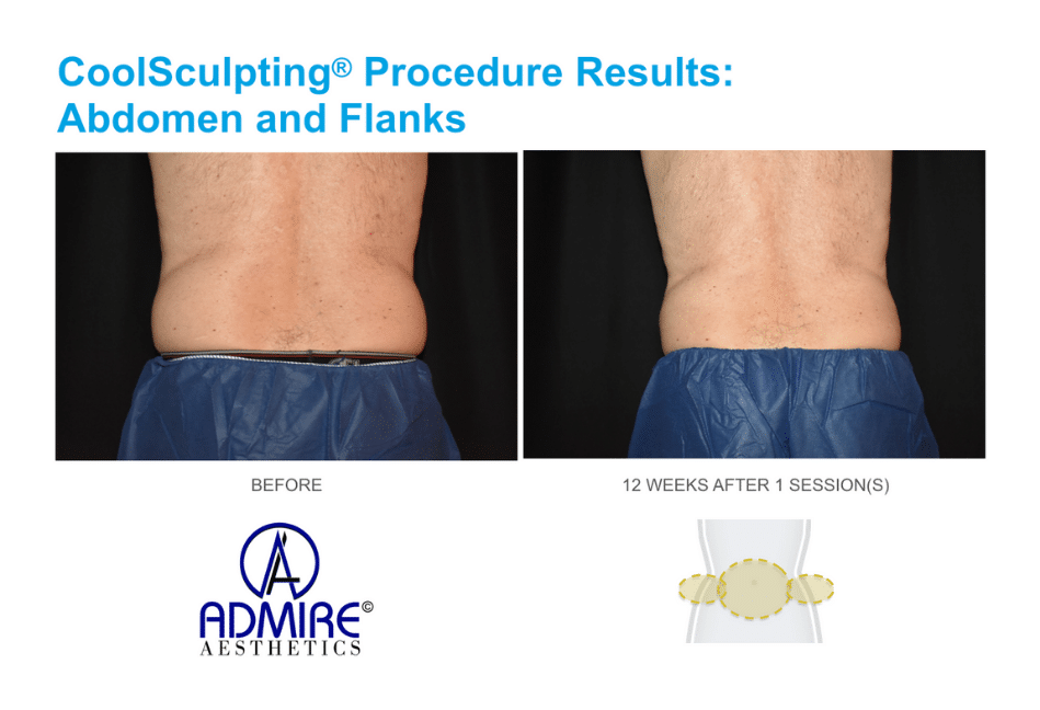 CoolSculpting-before-and-after-real-patients-admireaesthetics-12