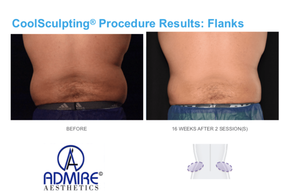 coolsculpting for men Love handles or flanks area in Medford, OR after body contouring treatment for men at Admire Aesthetics.