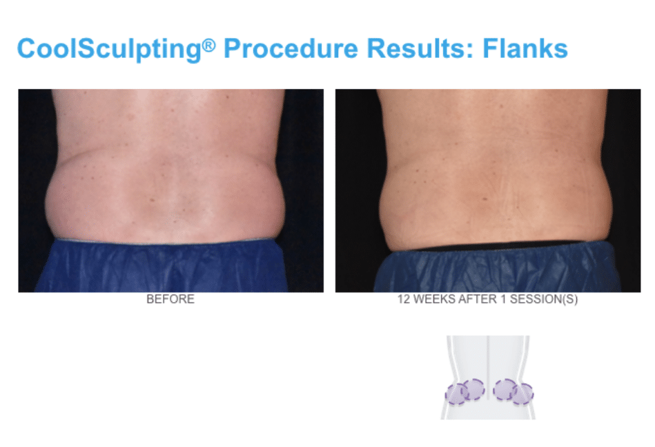 coolsculpting for men Love handles or flanks area at Admire Aesthetics body contouring treatment for men.