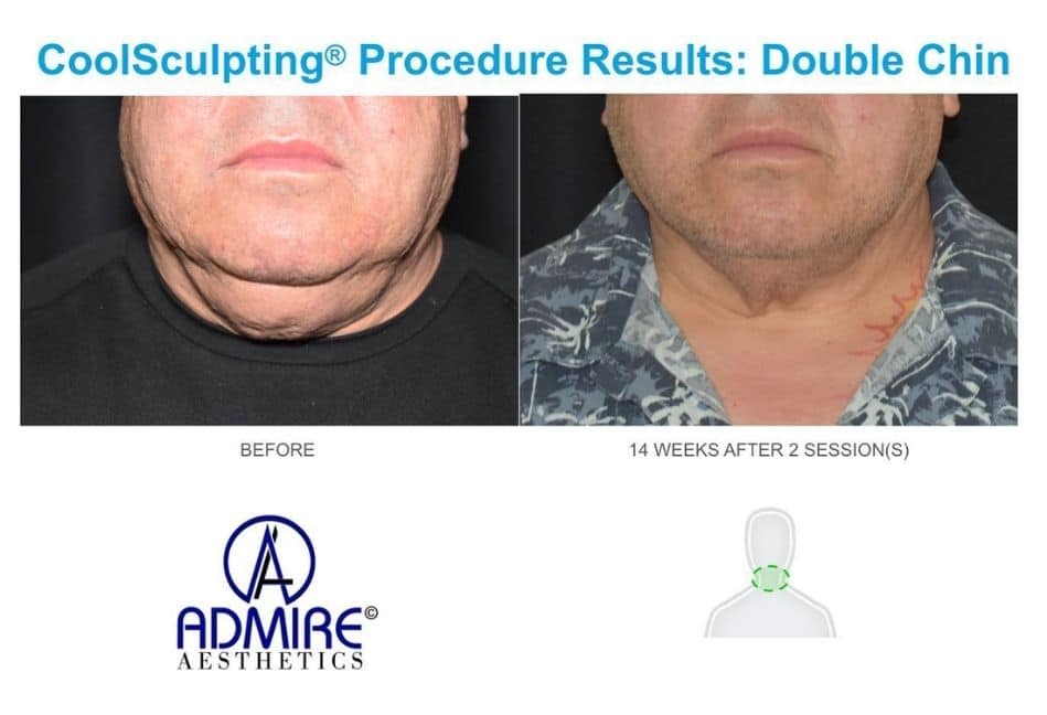 Man's double chin before and after coolsculpting treatment showing significant results after body contouring treatment for men at Admire Aesthetics.