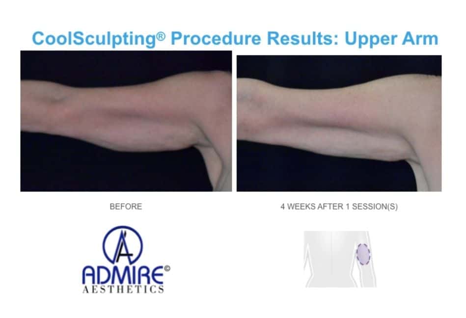 CoolSculpting-before-and-after-real-patients-admireaesthetics-4