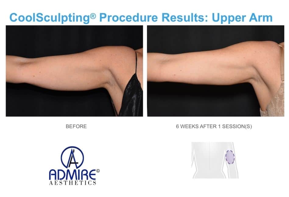 CoolSculpting-before-and-after-real-patients-admireaesthetics-5