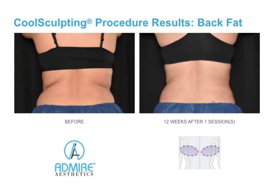 Love Handles CoolSculpting: Procedure, Results, Side Effects