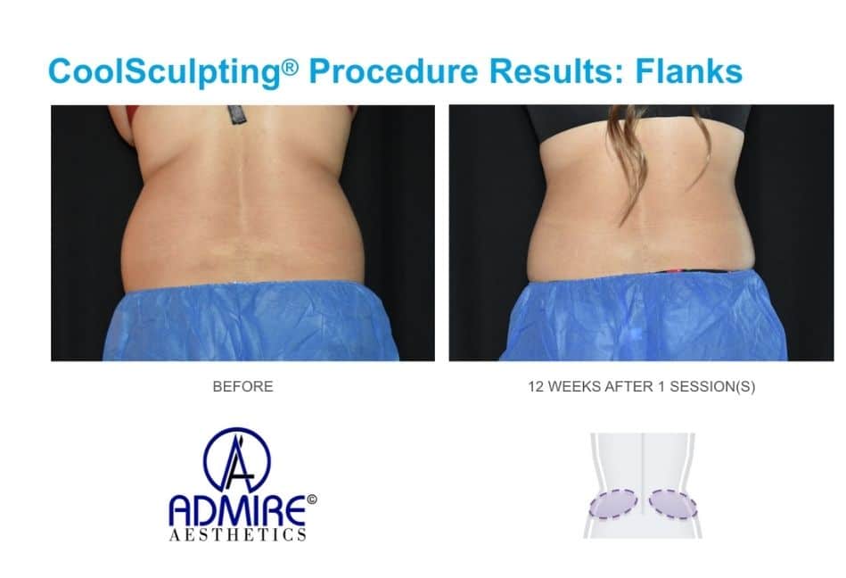 CoolSculpting before and after results from real patients