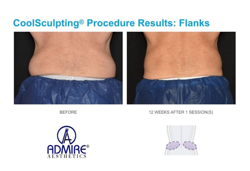 CoolSculpting-before-and-after-real-patients-admireaesthetics-8