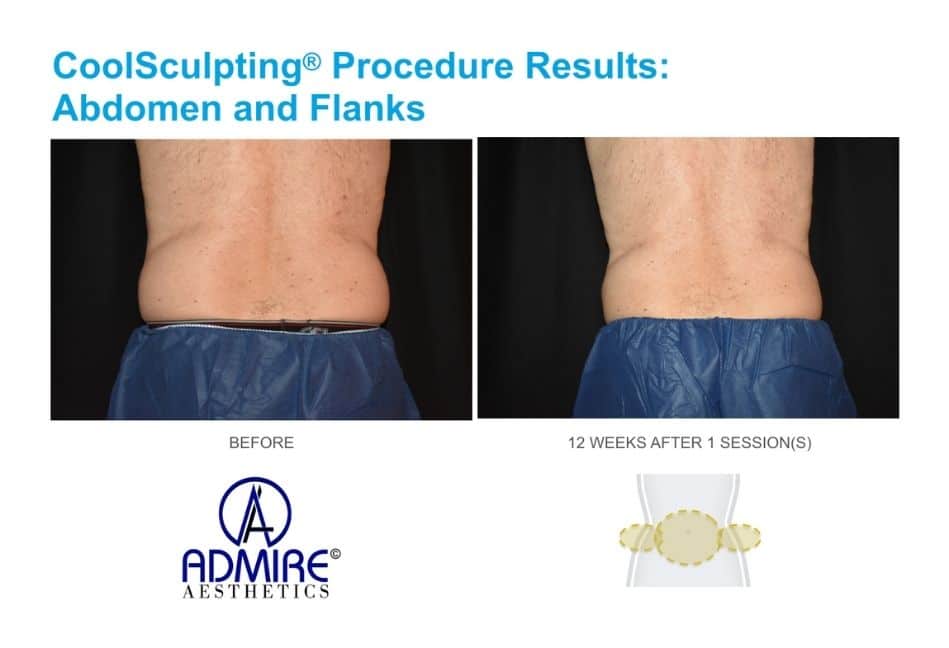 coolsculpting treatment abdomen and flanks areas, real patient at Admire Aesthetics body contouring treatment for men.
