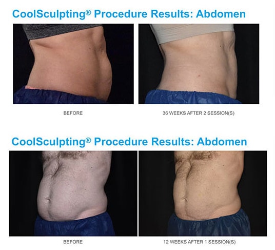 Coolsculpting before and after results by Admire Aesthetics in Colorado.