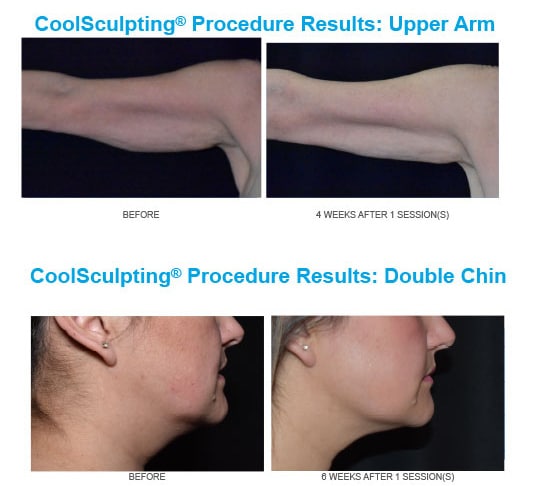 Coolsculpting before and after results by Admire Aesthetics in Colorado.