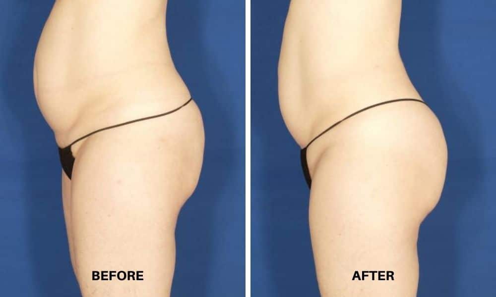 Womans before and after results from Velashape III body contouring and cellulite reduction treatment at Admire Aesthetics.