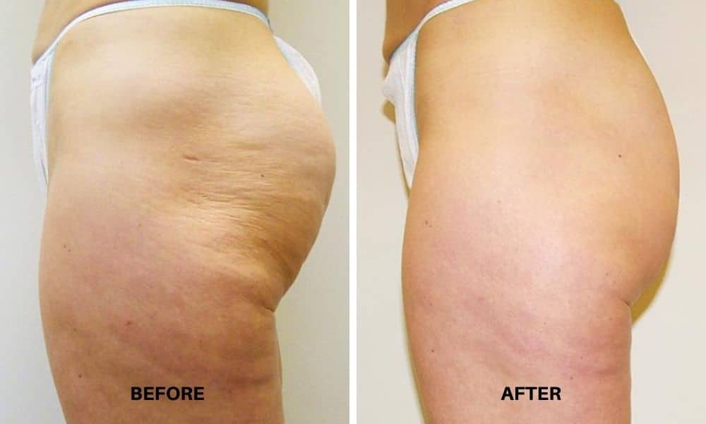 Womans before and after results from Velashape III body contouring and cellulite reduction treatment at Admire Aesthetics.