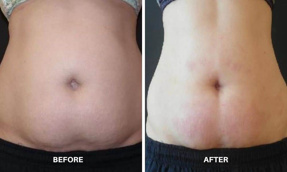 Womans before and after results from Velashape III body contouring and cellulite reduction treatment at Admire Aesthetics.
