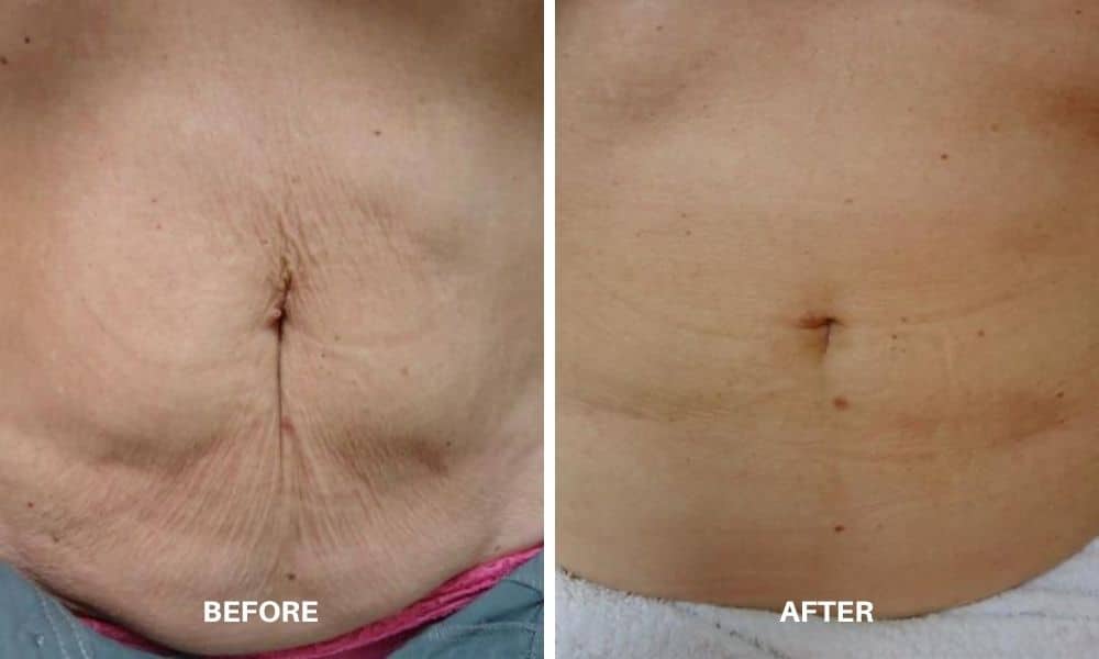 Womans before and after results from Velashape III body contouring and cellulite reduction treatment at Admire Aesthetics.