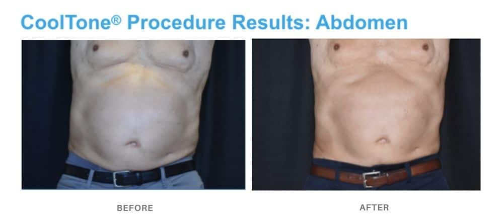 cooltone for men abdomen area at Admire Aesthetics