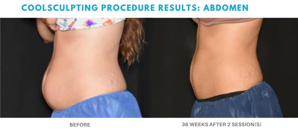 How CoolSculpting Significantly Reduced One Woman's Midsection