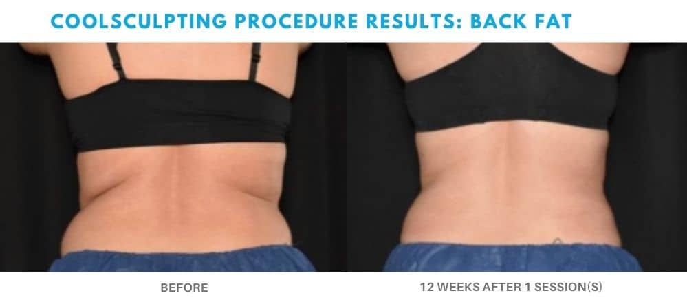 coolsculpting procedure back fat real patient result at Admire Aesthetics