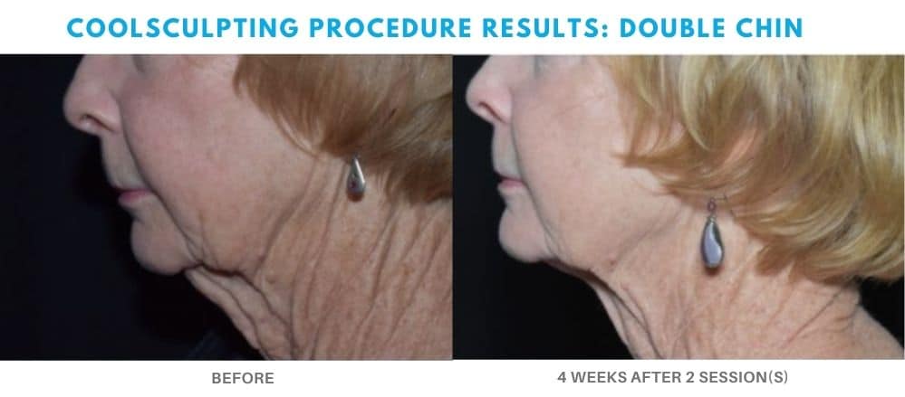 coolsculpting treatment double chin area real patient at Admire Aesthetics