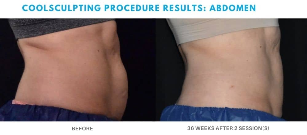 coolsculpting treatment abdomen area, real patient at Admire Aesthetics