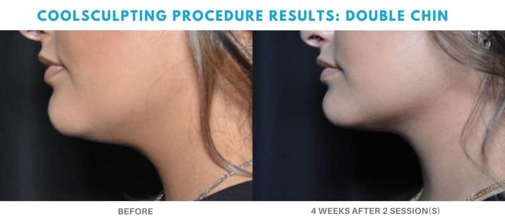 coolsculpting treatment double chin area real patient result