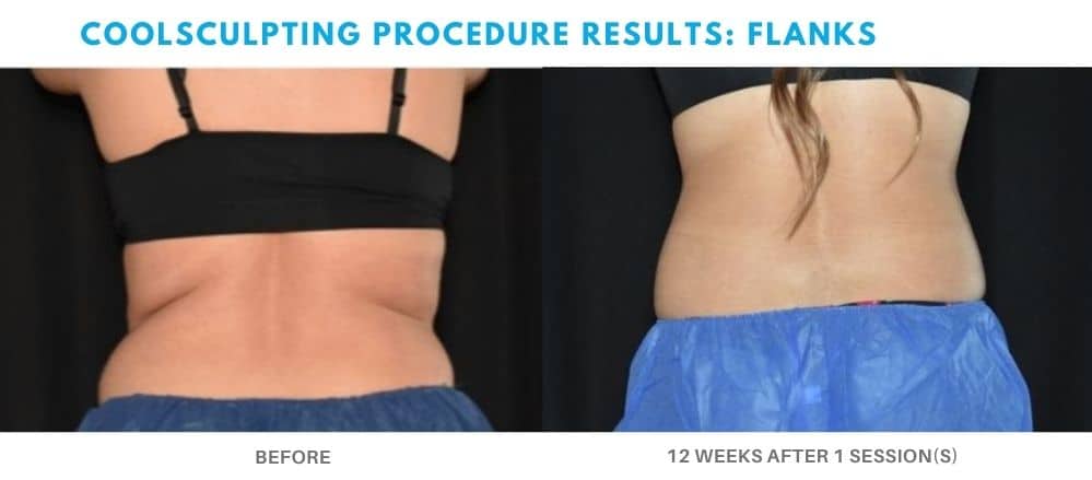 coolsculpting procedure flanks area real patient result at Admire Aesthetics