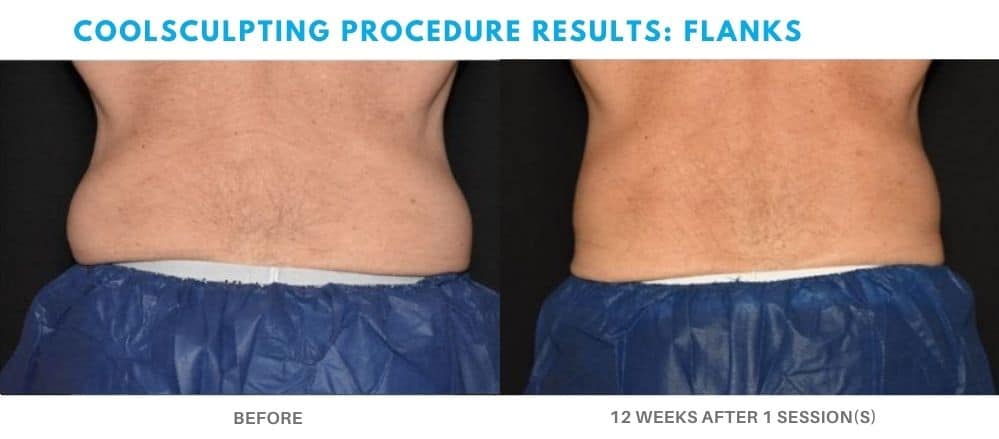 coolsculpting treatment flanks, real patient at Admire Aesthetics