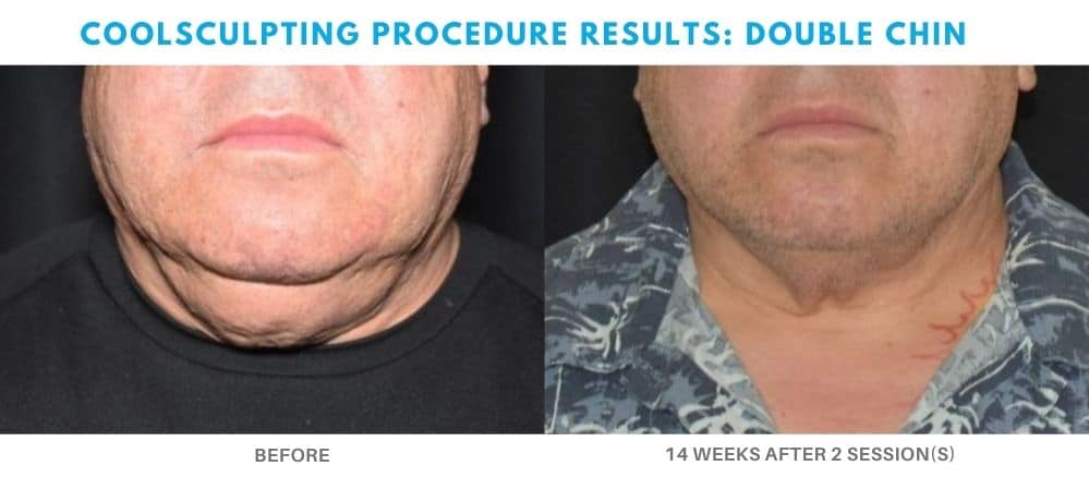 coolsculpting for men double chin area at Admire Aesthetics