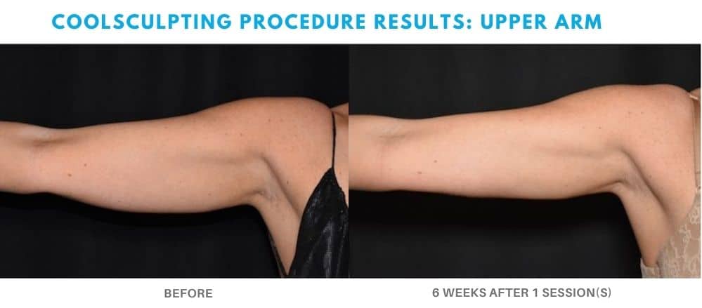 coolsculpting procedure upper arm area real patient result in Medford, OR