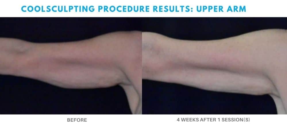 coolsculpting procedure upper arm area real patient at Admire Aesthetics