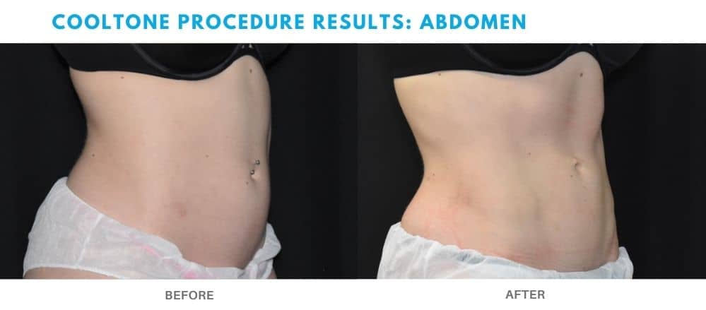 Womans abdomen before and after Cooltone treatment at Admire Aesthetics.