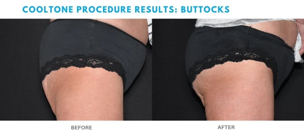 Womans buttocks before and after cooltone treatment at Admire Aesthetics.