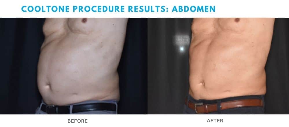 Mans abdomen before and after Cooltone treatment at Admire aesthetics.