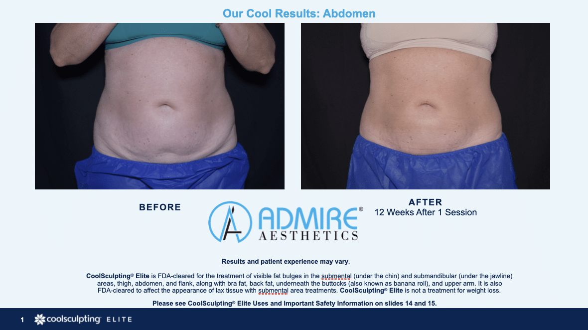 Womans abdomen before and after coolsculpting elite treatment at Admire Aesthetics.