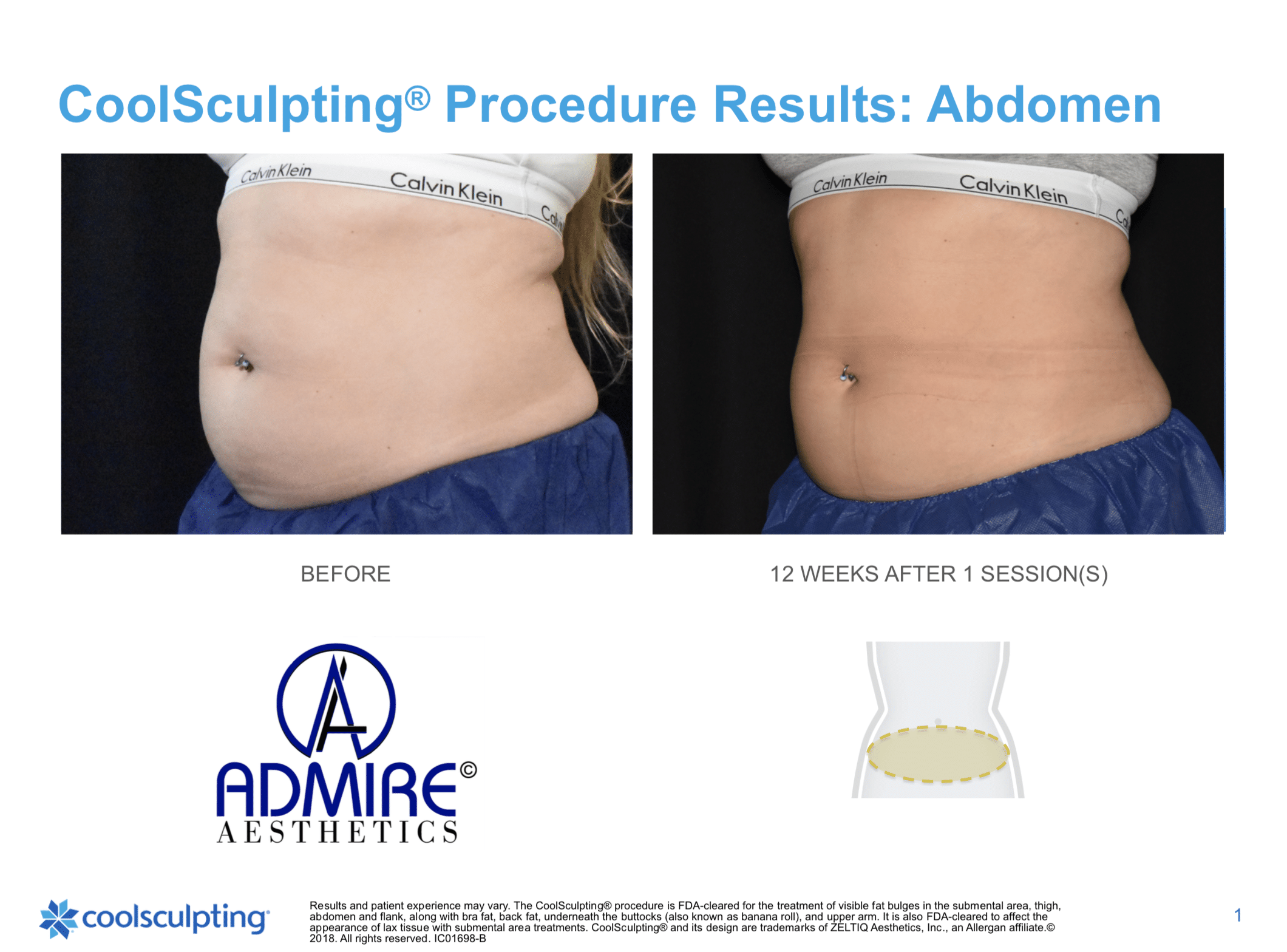 Womans abdomen before and after coolsculpting elite treatment at Admire Aesthetics.