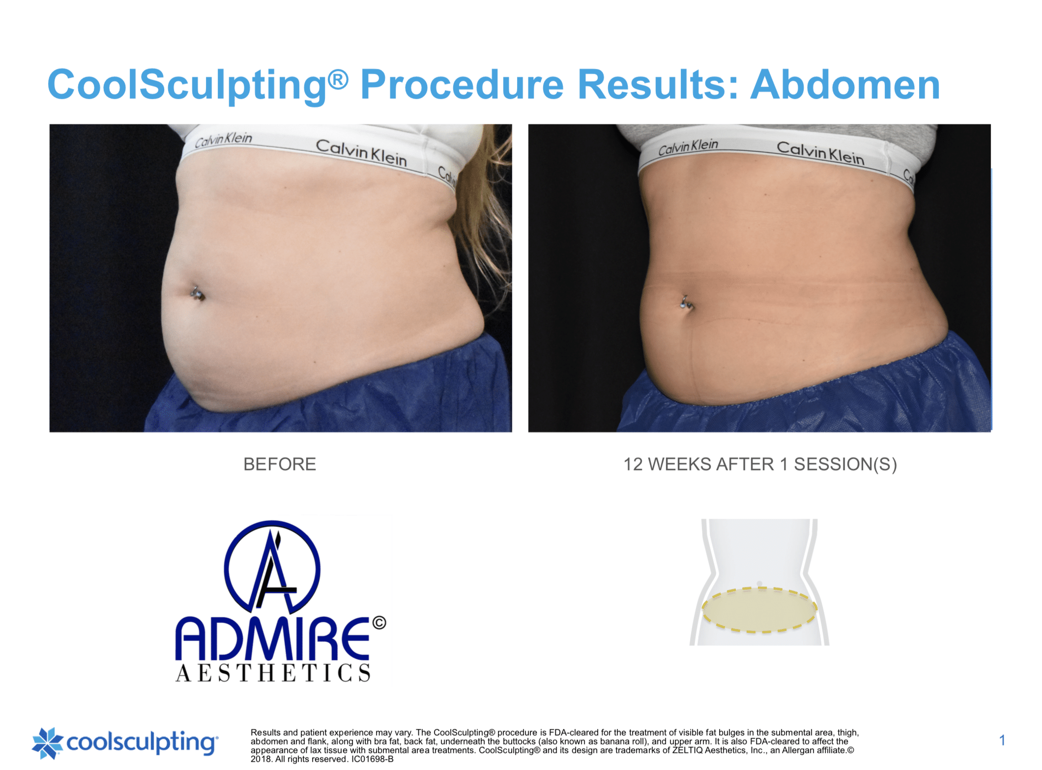 CoolSculpting Before and After Picture of Back Fat and Stomach