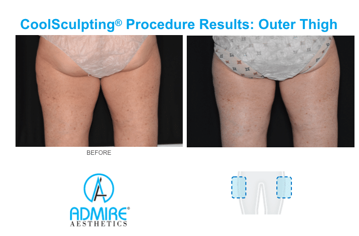 Buttocks before and after coolsculpting treatment at Admire Aesthetics.