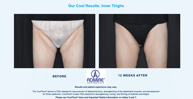 Womans thighs before and after coolsculpting elite treatment.