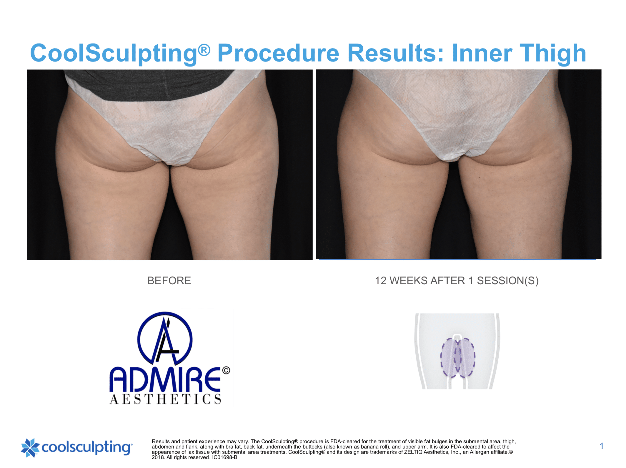 Buttocks before and after coolsculpting treatment at Admire Aesthetics in Medford, OR.