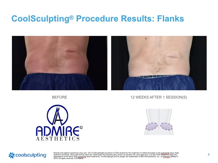 Womans back flanks before and after Coolsculpting treatment at Admire Aesthetics.