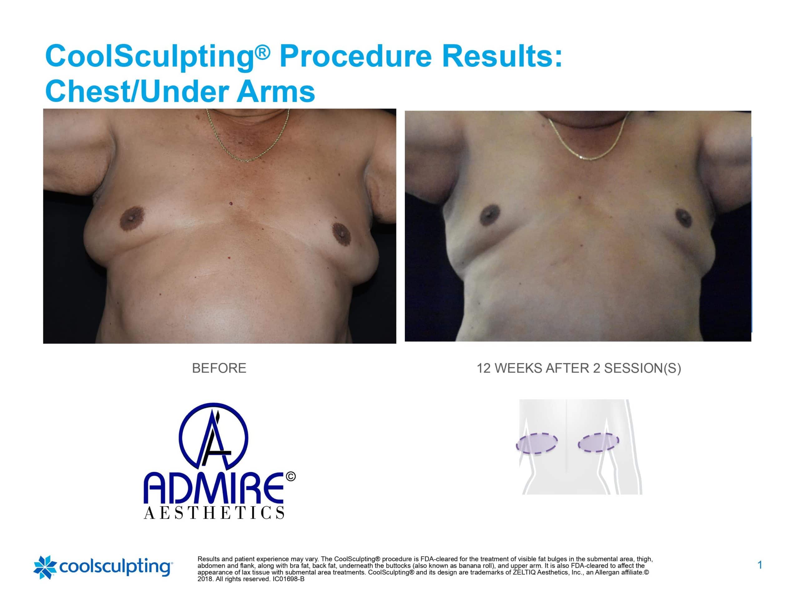 Mans underarm and chest fat before and after coolsculpting treatment at Admire Aesthetics.