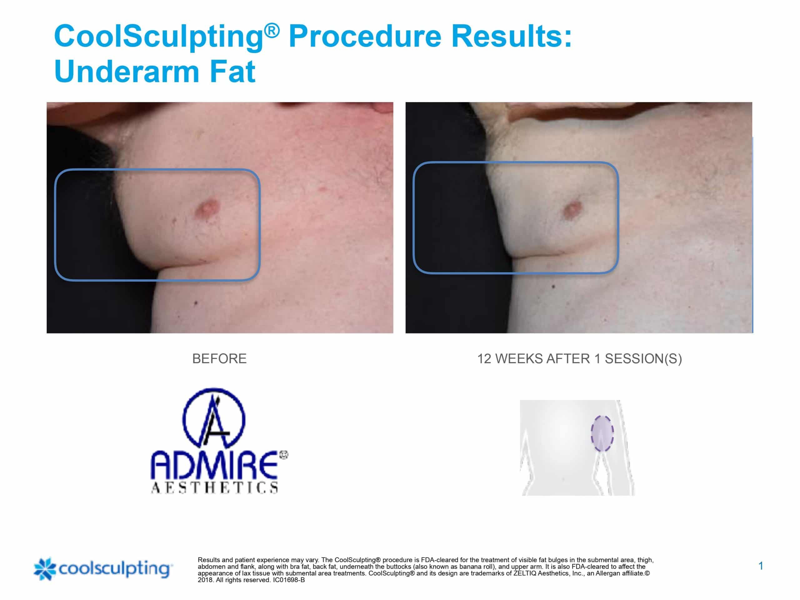 Mans underarm and chest fat before and after coolsculpting treatment at Admire Aesthetics in Medford, OR.